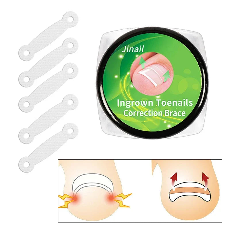 10PCS Ingrown Toe Nail Treatment Ingrown Toenail Correction Tool Elastic Patch Sticker Straightening Clip Brace Pedicure Tools